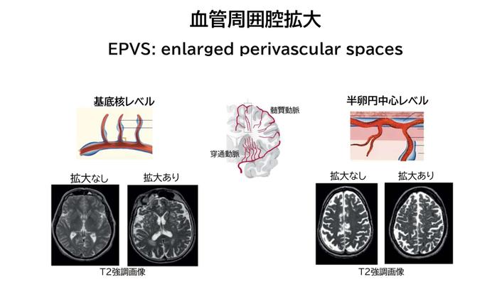 図2：血管周囲腔拡大について.