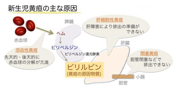 新生児黄疸の原因となる生体内の反応機構を世界で初めて解明